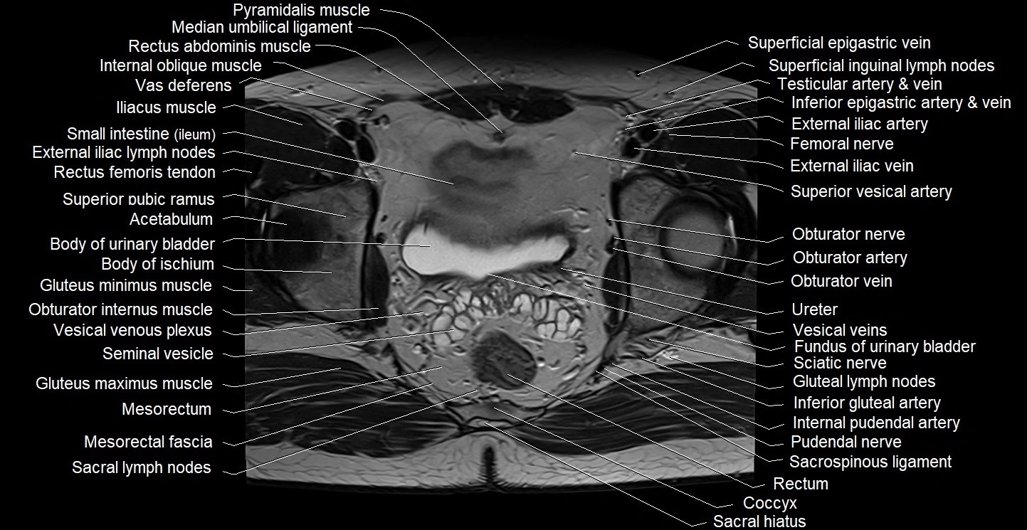 Male pelvis axial cross sectional anatomy image 24.webp